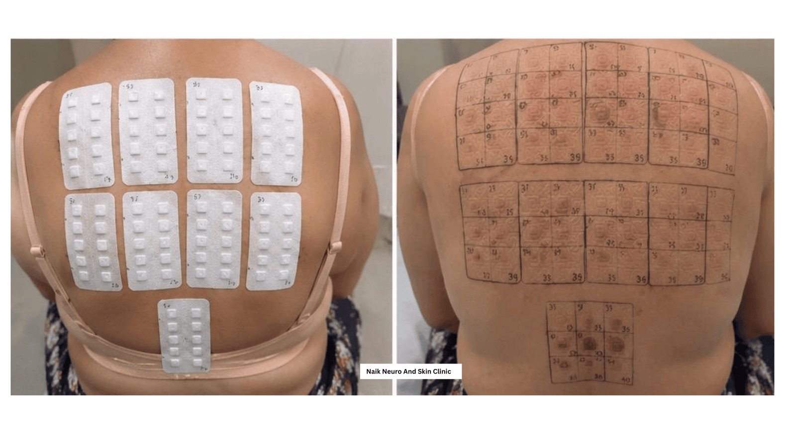 Patch Allergy Test 1