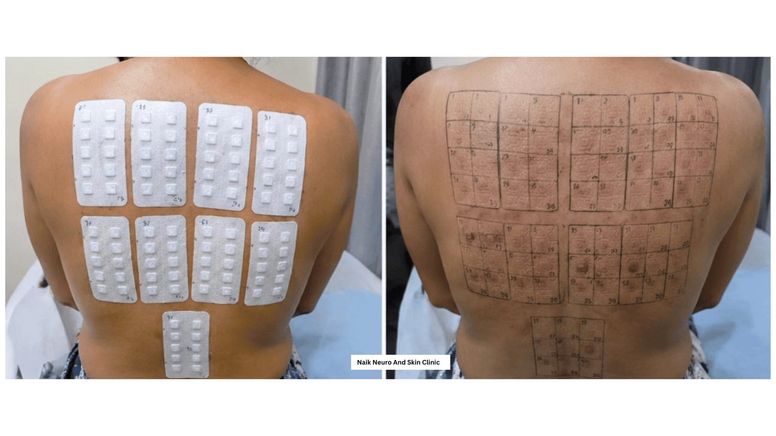 Patch Allergy Test 2