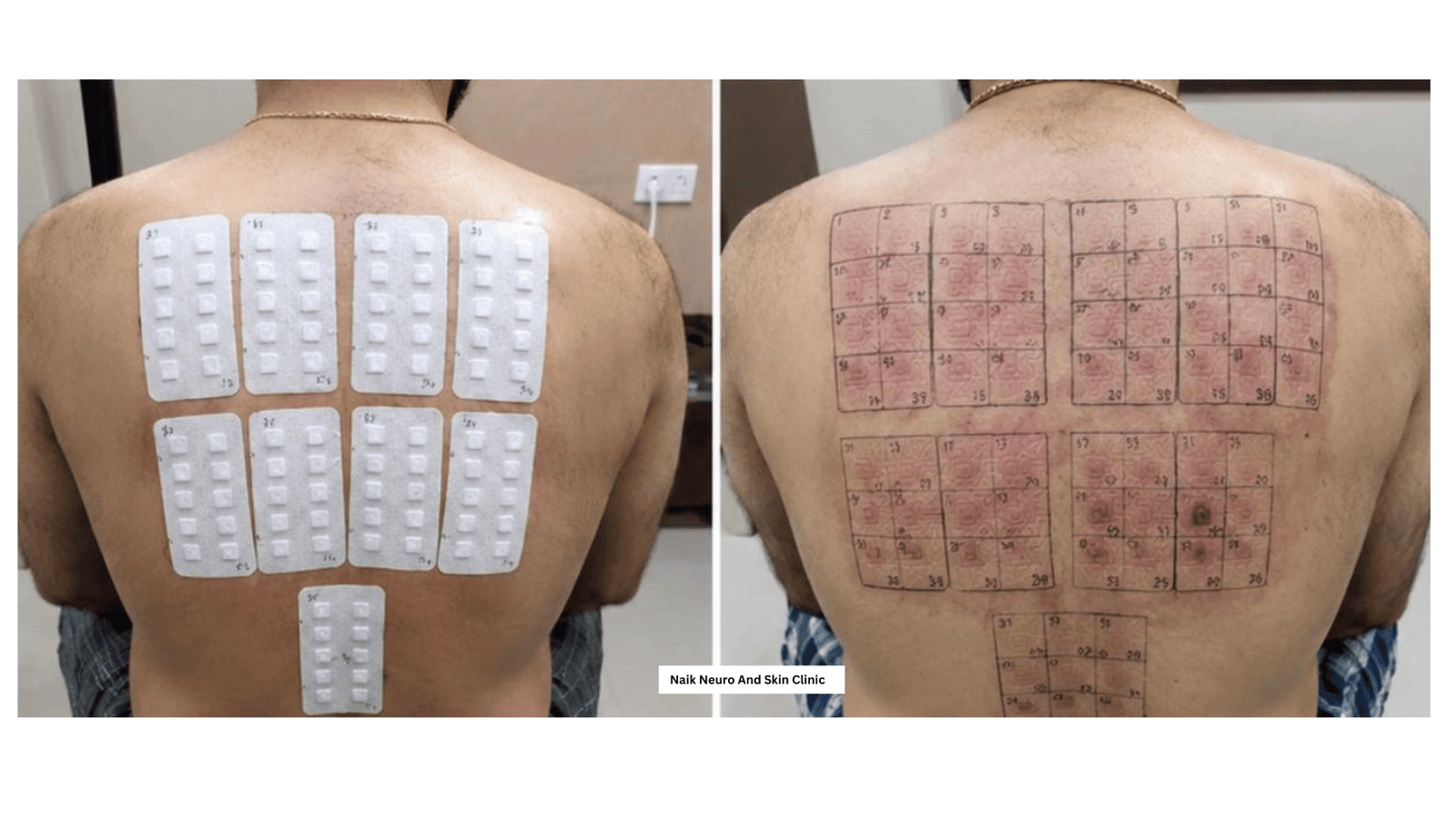 Patch Allergy Test 3