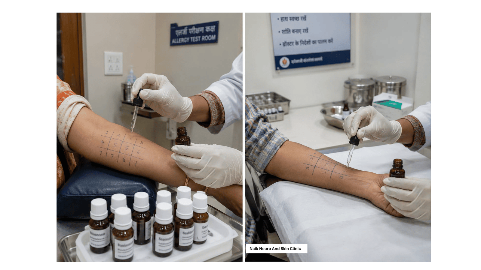 Prick Allergy Test 1