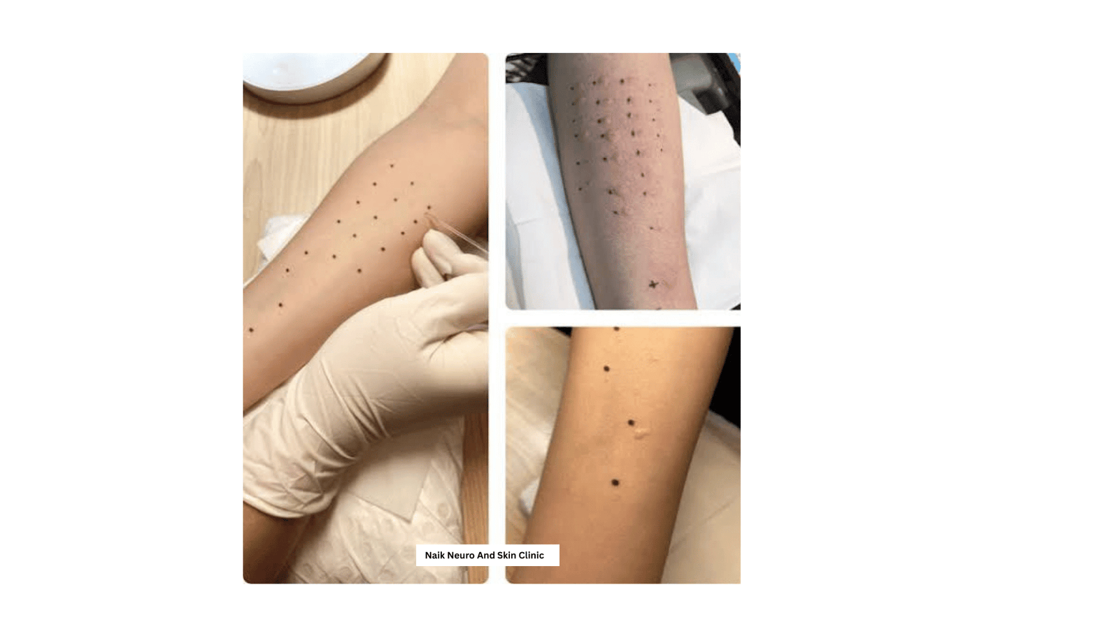 Prick Allergy Test 2
