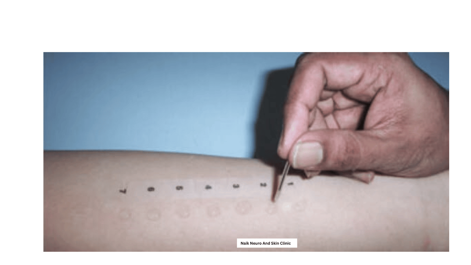 Prick Allergy Test 3