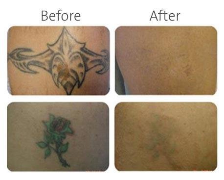Laser Treatment